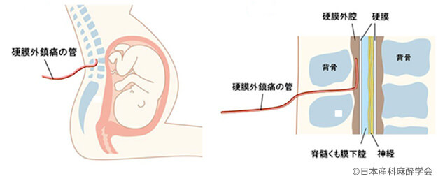 無痛分娩の実際